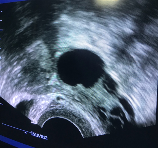 19号B超检测左侧卵泡
