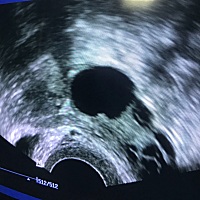本人33岁 备孕2年 ，去年8月宫腹腔镜手术后，休息半年今年3月开始备孕。3.19B超检测卵泡左侧2.2 立即打...