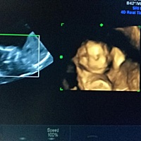 姐们儿说，等24周再来查四维，胎儿脸蛋上就长出来肉肉了，这个时候看的更清晰了。