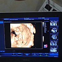 宝妈们谁会看NT单子？帮忙看下男宝女宝？