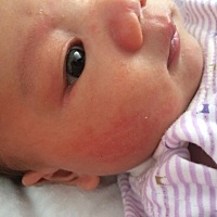 宝宝湿疹怎么办，大宝都没长过