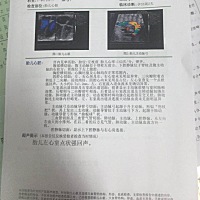 有没有知道这个左心室点状强回声是怎么回事的呢？有什么后果？还有没有办法改善的啊，结果出来就焦虑不...