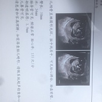 第一个宝宝，NT正常，不知道男孩女孩，😜😜