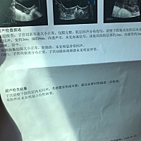 子宫憩室打算要二胎的有吗，医生建议修复再生，好纠结，在网上看到很多说直接怀，又怕到后期大出血，怕怕呀