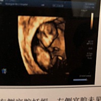 胎盘位置低怎么办