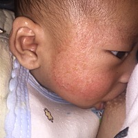 宝宝有奶䉳而且很严重 怎么办有什么可以治疗方法办帮帮我我什么都不帮 这几天痛的他想睡觉都发脾气了 无...