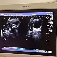 只有一侧输卵管，多年前因为宫外孕切除一侧输卵管，七年前，现在想要宝宝，只有一侧，四年前做的造型是...