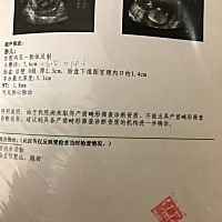 跪求大神帮我看看NT 报告单，谢谢你们了，么么哒