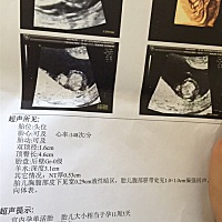 今天去做NT，结果不好，NT厚0.53，还有水肿。医生说是上级医院检查，是不是应该拿掉啊？