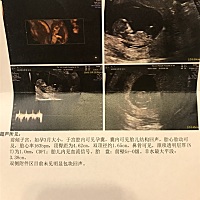 今天刚测的NT 能看出是男孩女孩吗😊