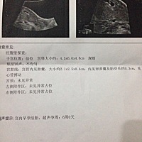 有胎心胎芽了，暂时放心了，祝大家好孕