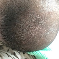 我家宝宝的头垢，舅舅屎奶痂是怎么去除的？      我家宝宝出生后一个月左右，在头顶上出现了痂一样的东...