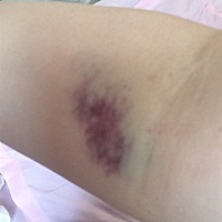 血压高血糖高就是降不下去，天天打十几针，啥也不能吃，定的医院的糖尿病人餐，宝宝胎动少，真不知道怎...