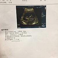 NT归来，一切顺利，我的宝宝很棒！分享一下此时的心情！我们一起加油，我的小小宝贝！！