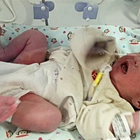 各位宝妈帮忙看一下宝宝腿上紫一块是怎么了，今天早上出生的