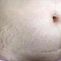 秒杀娇韵诗和帕玛氏的妊娠纹霜 Rilastil 本人164cm，孕前90斤，怀的男宝，妊娠反应几乎没有，因为爱美,...