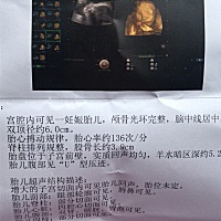 23周。  眼距离这么宽正常吗？