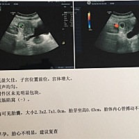 2月11日末次月经，一直有褐色分泌物，今天照B超大夫说胎芽比上周变小了，也没有胎心，是空囊，建议做掉...
