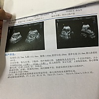 宝妈们，有遇到过这种胎儿大脑双侧长肿瘤的吗？