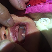 宝宝出生一个星期，嘴里出这种东西，谁知道这是什么？