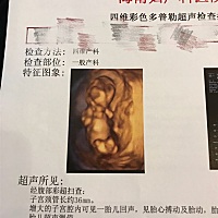 今天做了NT，崽崽起先好懒趴着照不到脸和手脚，医生说让我去疯狂爬楼梯，费好大的劲儿才翻了个身，谢谢...