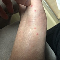 这是怎么回事？不痛也不痒，一开始有一点时以为是蚊子咬的。