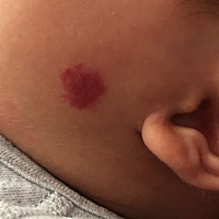 宝宝脸上这个红色的是什么大家帮忙看看。生下来没有这个红点