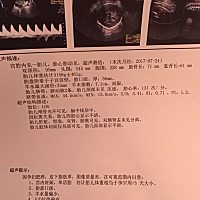 今天做最后一次B超，羊水偏少！胎儿已入盆，让我担心就是羊水偏少。有没有宝妈跟我情况一样的，我之前一...