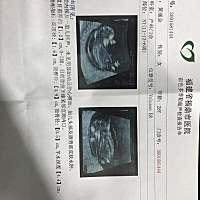 心痛到无法呼吸 3个月零3天 做NT说没有胎心了