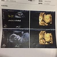 今天去做四维彩超了，第一次跟宝宝见面，好神奇，第一胎，也很好奇宝宝是男孩还是女孩，大家帮我看看