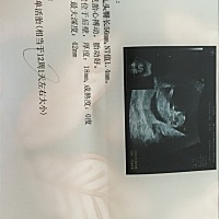 2周前检查有液性暗区回声且孕酮低，今天NT结果出来，终于安心了🙏