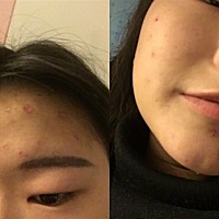 给你们我姨妈期间的痘痘