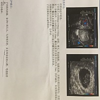 朋友们，你们谁有没有上个星期检查正常，一个星期后检查有问题的？有没有那个突然没有胎心的？现在心塞...