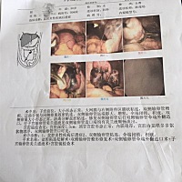 做了伞端造口术，会怀孕吗