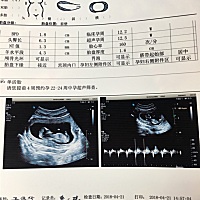 今天刚做的nt，有哪些孕妈妈可以看出来男孩女孩？