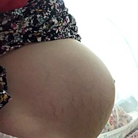 37周，严重的妊娠纹，肚皮废了