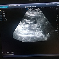 有没有宝妈知道这个的，我这没长好，有小黑点，所以流血，需要多久才能恢复好？