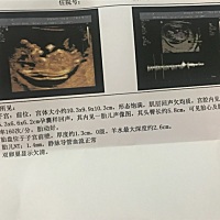 二宝3个月能看出男宝还是女宝吗？明天去做唐氏筛查