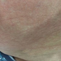 怀孕12周，肚子上长湿疹，奇痒无比，晚上都无法入睡，孕期湿疹怎么治疗，求助