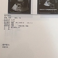 今天刚做了唐筛 还没出结果。愿一切顺利！！