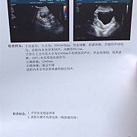 急急急!!!   右侧卵巢长了一个畸胎瘤，会不会影响怀孕，大姨妈都不来了，是怀孕一起做还是先做掉，有没...