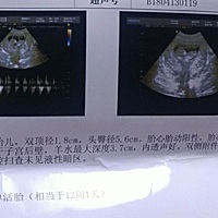 孕宝的姐妹们猜猜我家这个是男宝还是女宝～☺️