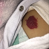 宝宝用血瘤凝胶慢慢淡化了，很高兴，-希望宝宝早日康复