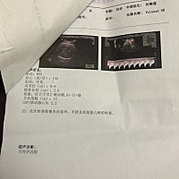 超预产期三天了 医生说宝宝有点大 不知道好不好顺产 自己身高有168