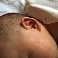 宝宝脸上好多热疹子怎么办，是太热了吗？穿的也不多啊