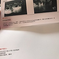 孕9周多，昨天去检查没有胎心，医生建议流产，我决定保胎一周，不知道会不会有奇迹发生