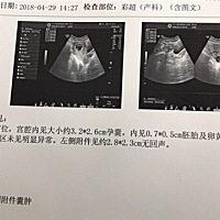 有个什么囊肿 有大问题吗？ 50天的B超单 怎么看男女🤣🤣🤣