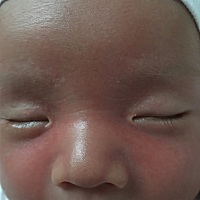 宝宝鼻子两边怎么那么红啊，有宝妈知道怎么回事吗？