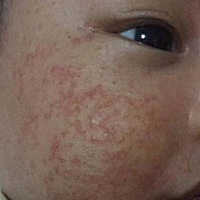 我家宝宝也是起了满脸湿疹，刚开的起我妈不让管，总说宝宝都起湿疹正常反应，导致宝宝现在这么严重，总...