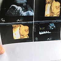 1月的四维，大家觉得像男宝还是女宝呢？？？？今天做的胎监，预约不到医生，有人懂这宫缩像快生了吗？